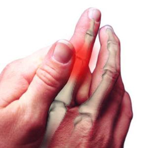 Αρθρίτιδα των δακτύλων: θεραπεία, αιτίες, συμπτώματα